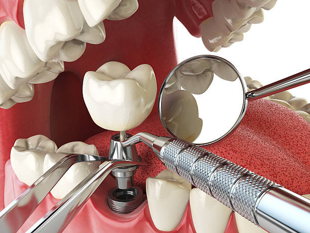 Best Emergency Dentist for Lost Fillings or Crowns in Hanover, OH